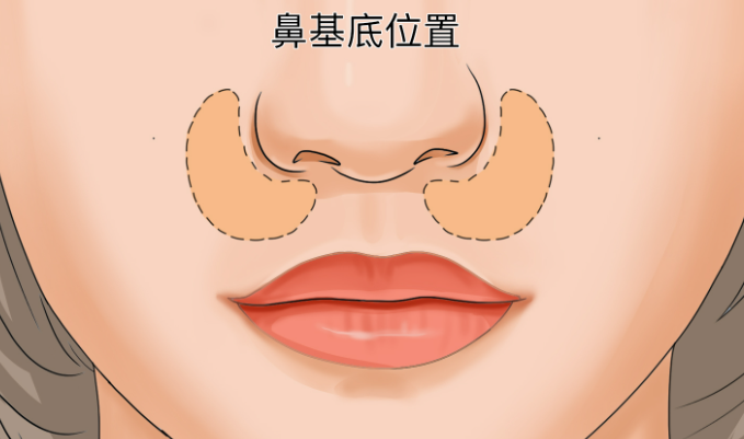 二、丁昆琨醫(yī)生拉皮手術(shù)的技術(shù)解析