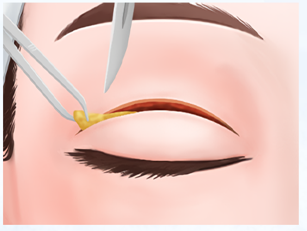 南昌張效恩醫(yī)生雙眼皮手術價格貴嗎？