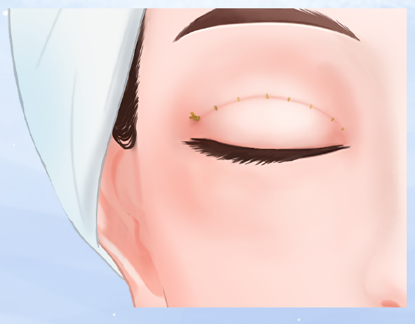 南昌張效恩醫(yī)生雙眼皮手術價格