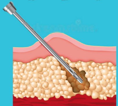 杭州鄭紅革吸脂怎么樣？