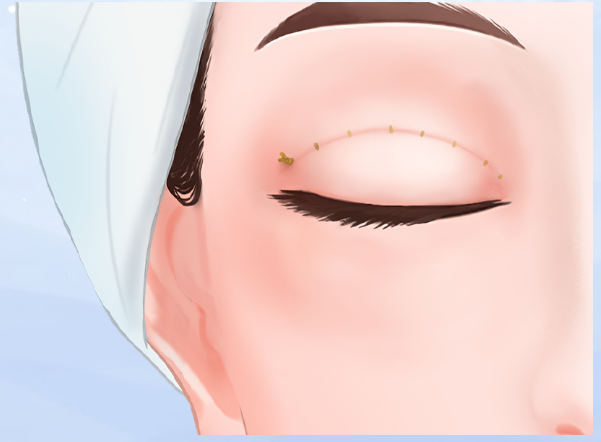 成都梁軍雙眼皮做得怎么樣?