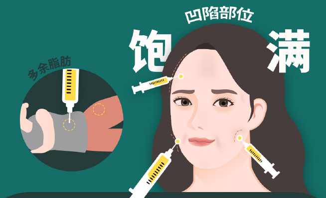 張讓虎做自體脂肪填充審美在線