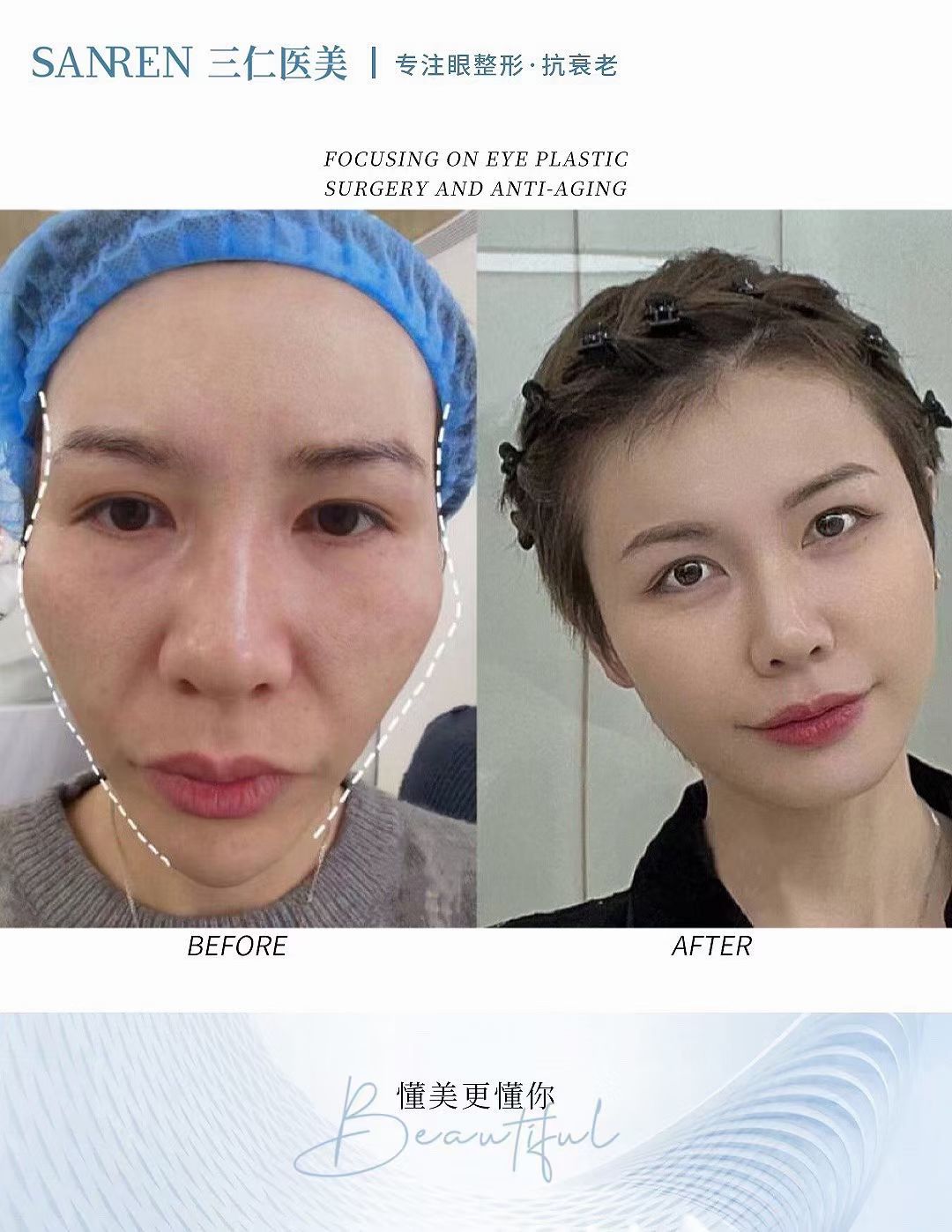 韓雪峰：熟知顳區(qū)解剖，注射更精細(xì)