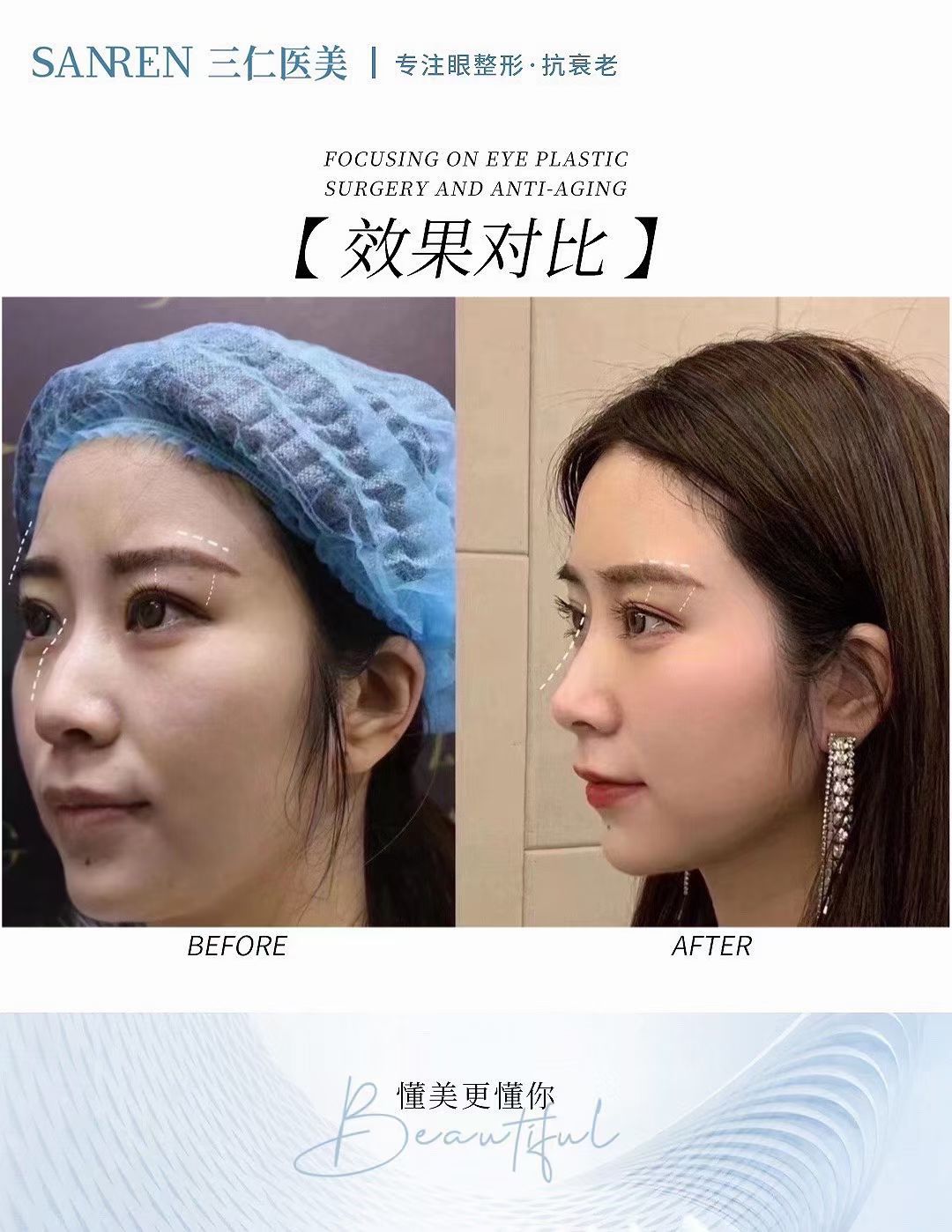 韓雪峰玻尿酸顳部注射常見問題解答www.sorencai.cn