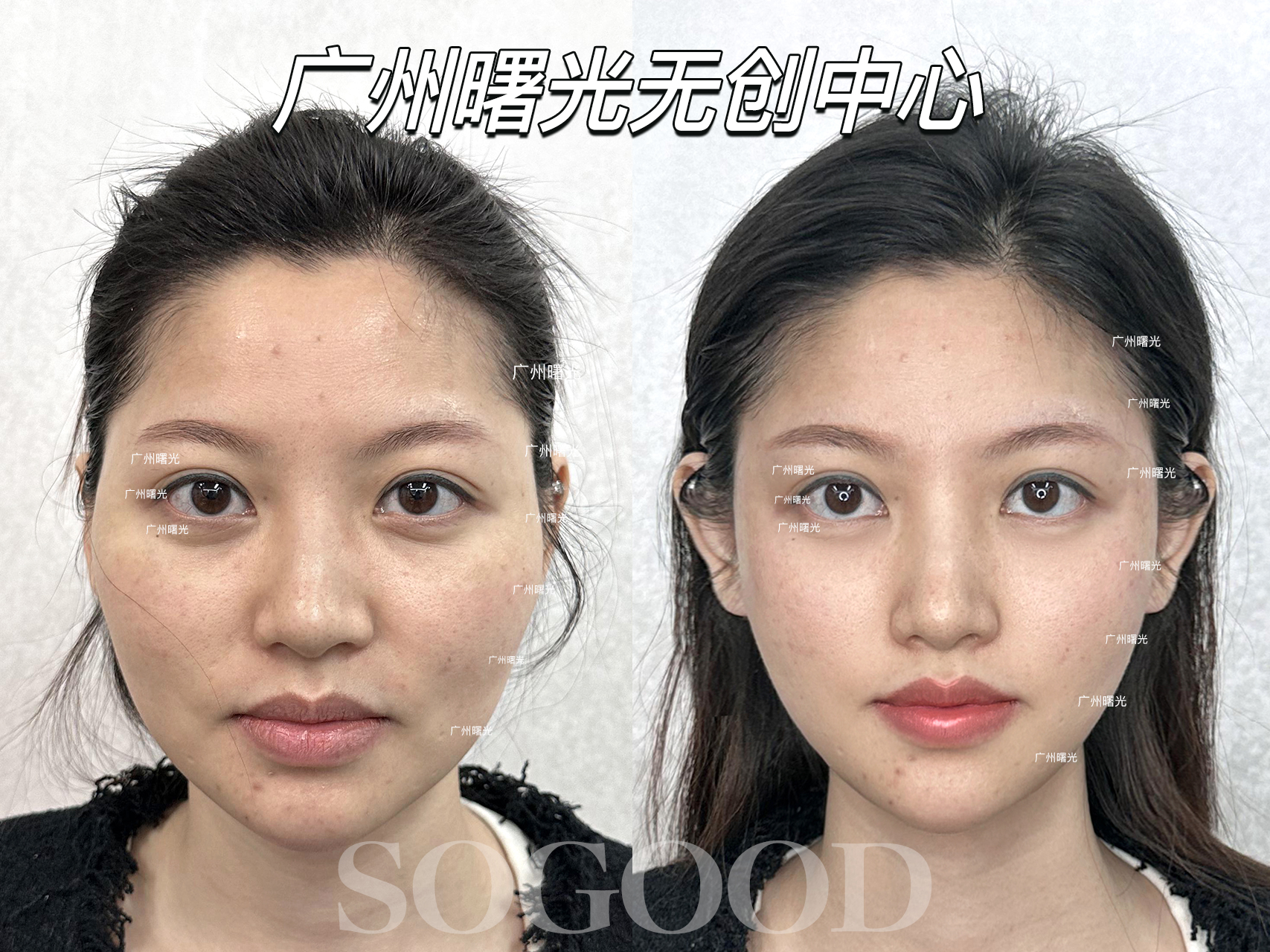 張曉棠醫(yī)生大拉皮技術(shù)為啥牛