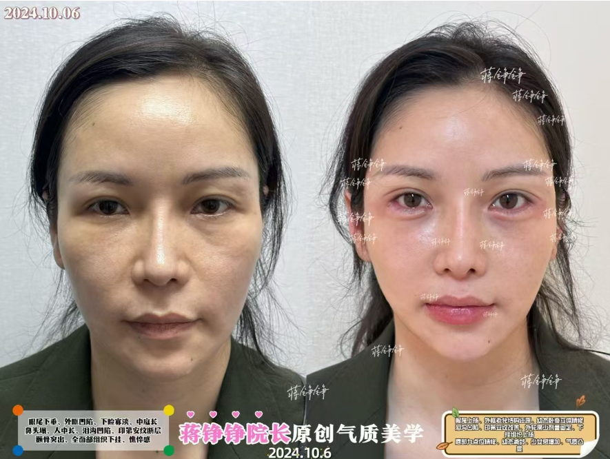 三、2026年主打項目推薦：幼態(tài)臉注射火爆來襲！