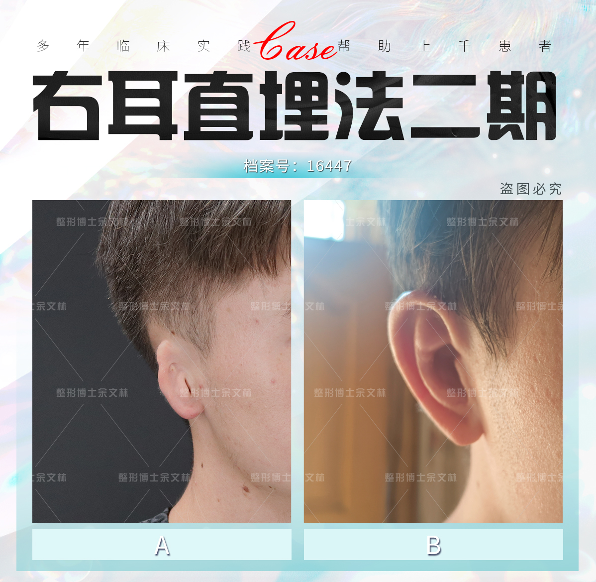 2026外耳再造技術(shù)詳解：自體肋軟骨 vs 生物支架（Medpor/Su-por）www.sorencai.cn