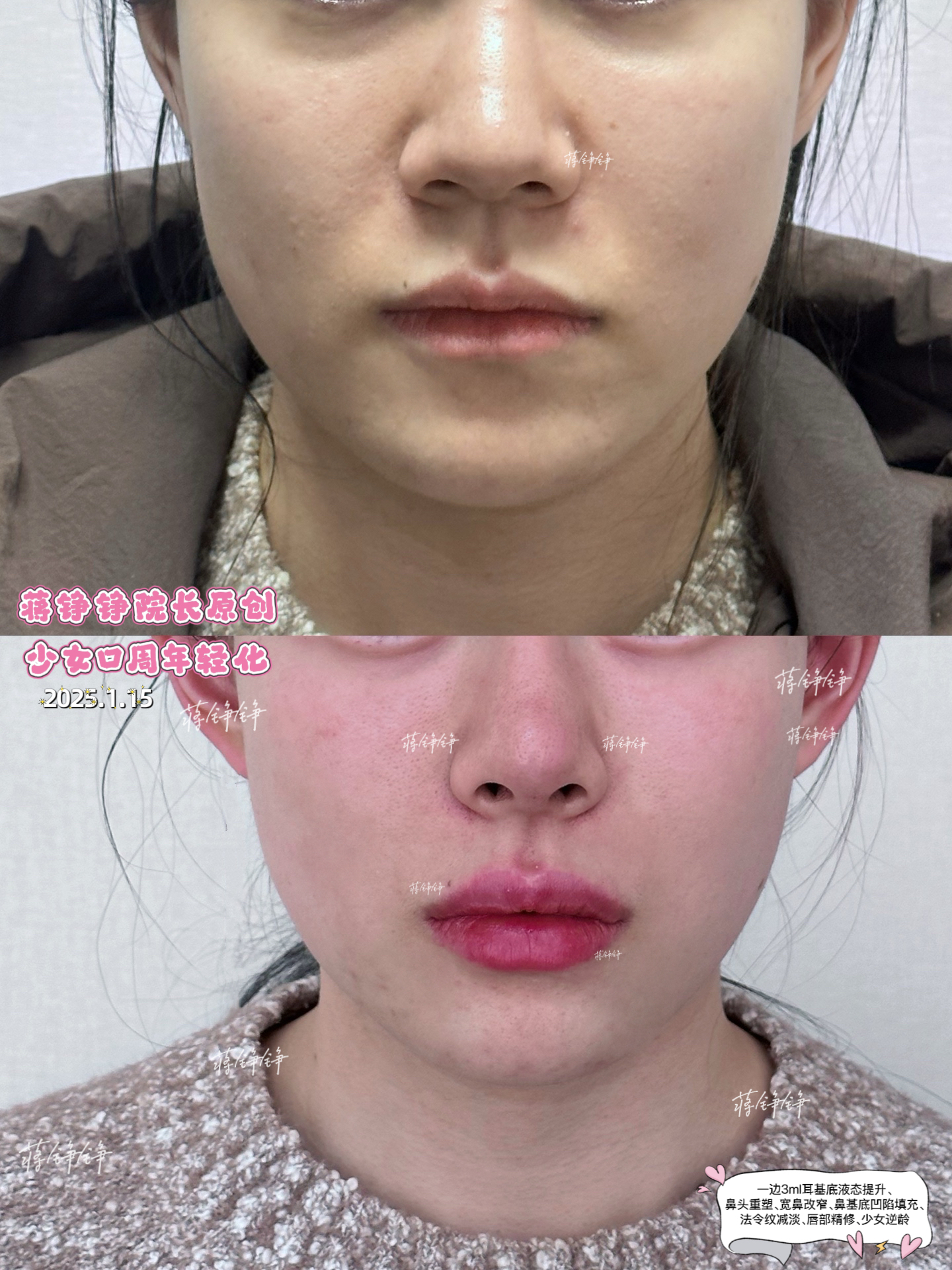 韓雪峰醫(yī)生注射：總結(jié)與建議