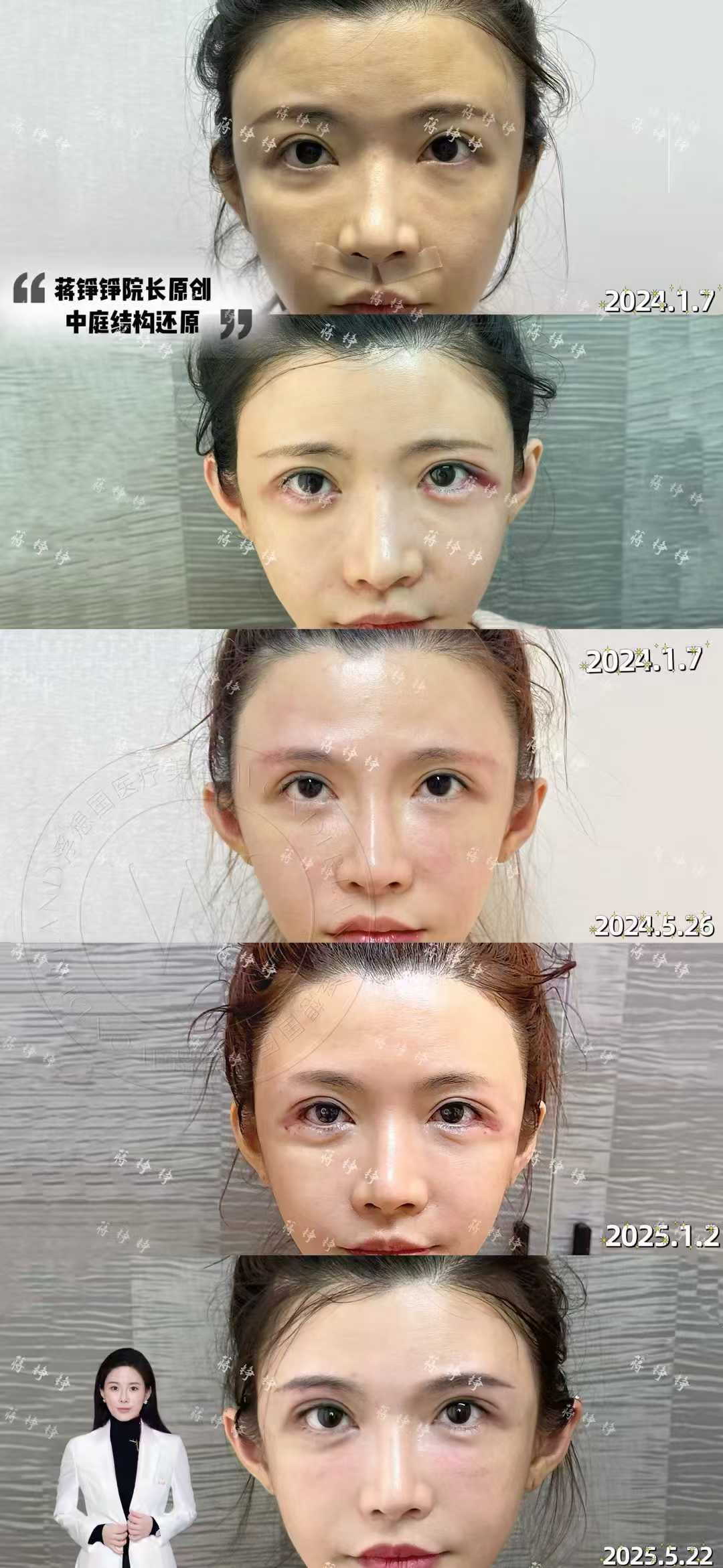 二、李花停和蔣錚錚技術風格對比：誰的注射更自然？