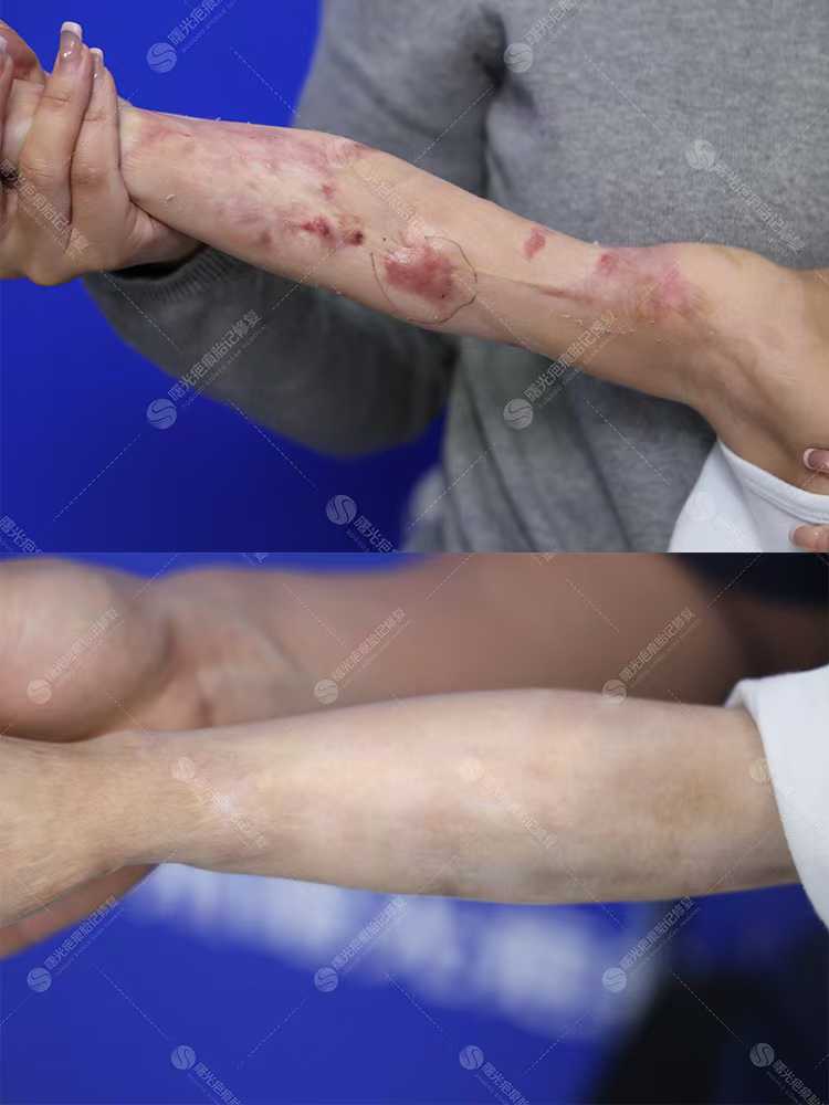 濟南去疤痕哪家醫(yī)院好？山東大學(xué)齊魯醫(yī)院技術(shù)優(yōu)、服務(wù)全助你告別疤痕！