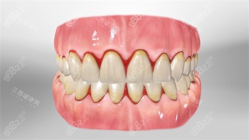 牙齒根部牙齦出血