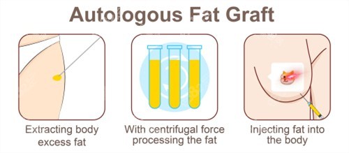 自體脂肪隆胸 自體脂肪隆胸