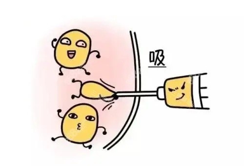 抽脂漫畫(huà)示意圖 抽脂漫畫(huà)示意圖
