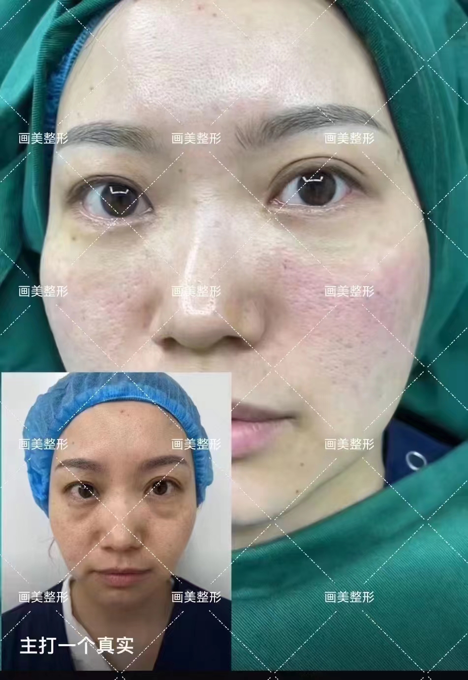 華 西伍俊良祛眼袋：預(yù)約與注意事項