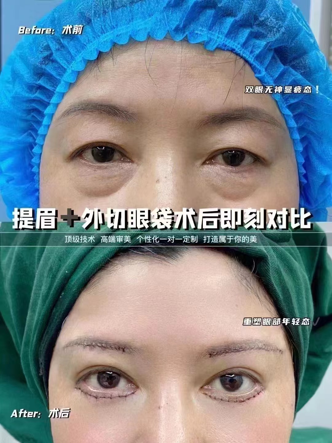 伍俊良外切眼袋55歲患者適配性良好