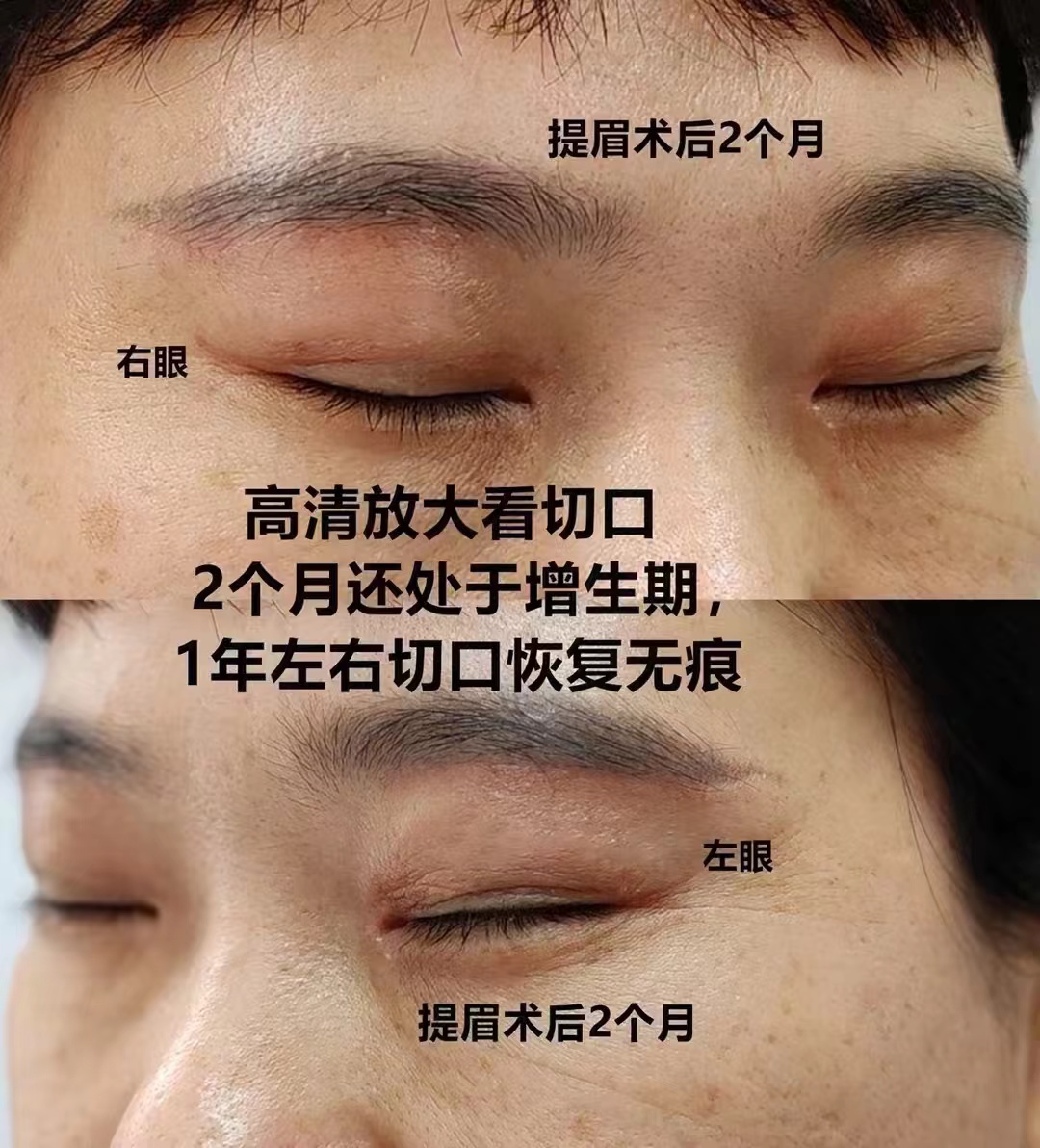 伍俊良外切眼袋術(shù)后修復過程及成效呈現(xiàn)