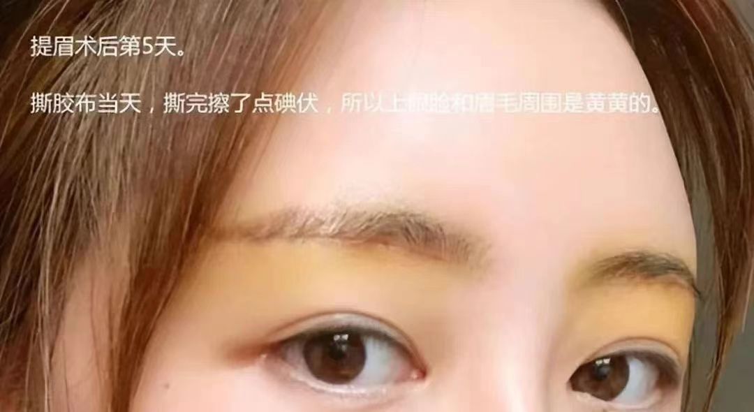 伍俊良外切眼袋55歲患者就診攻略實用www.sorencai.cn