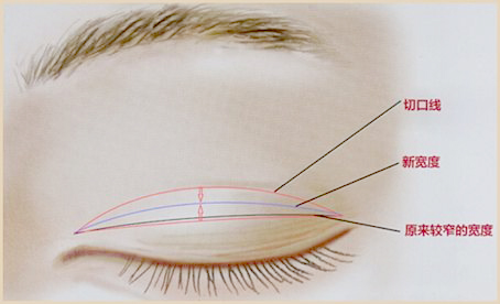 五、如何判斷李斌做雙眼皮的費用是否值得？