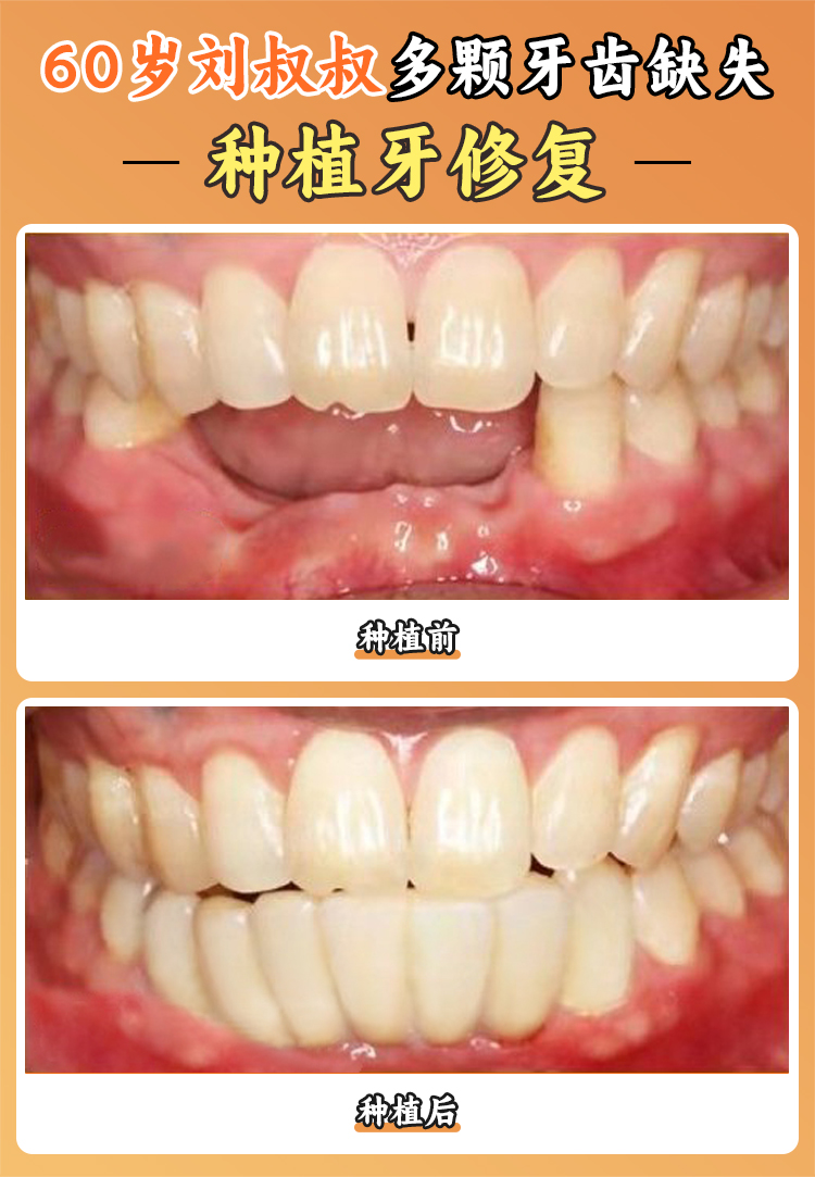三、2026年補牙、拔牙、洗牙等基礎項目價格