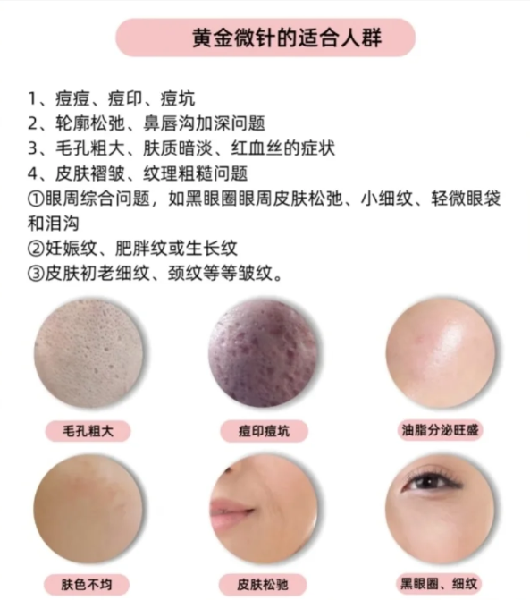 三、半島黃金微針4.0和5.0到治療成效與適用人群