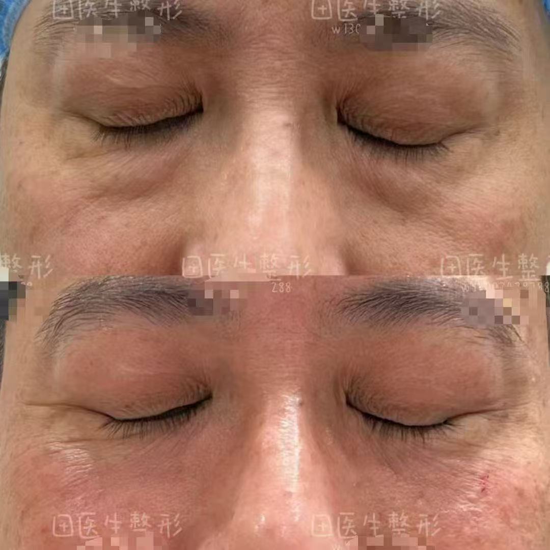 華 西伍俊良祛眼袋：患者口碑與榮譽加持