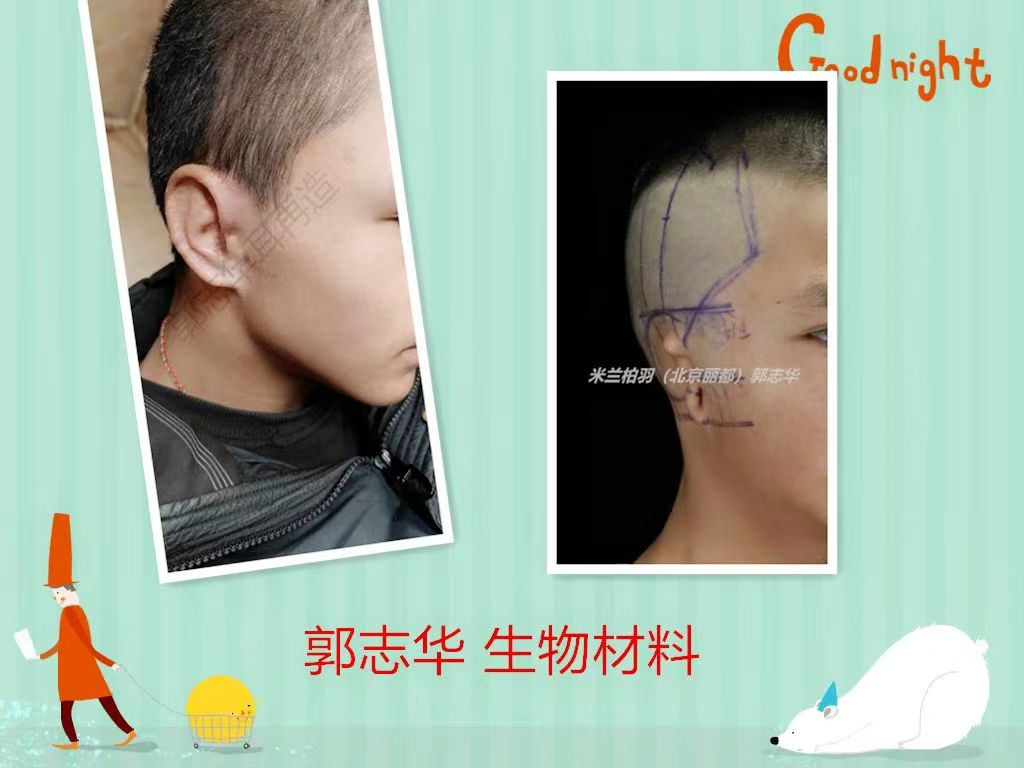 與傳統(tǒng)肋軟骨手術(shù)的對(duì)比