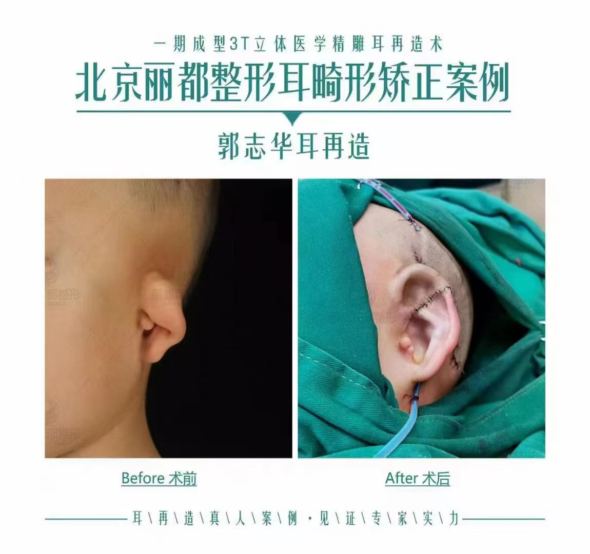 適合哪些孩子做Su-por耳再造？