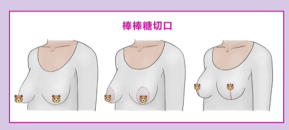 武漢包濤脂肪胸存活高嗎？醫(yī)生專門背景解析