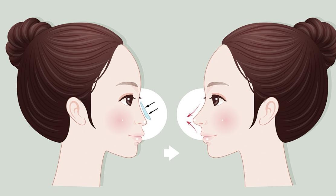 三、潘峰醫(yī)生隆鼻實(shí)例分享與療效分析www.sorencai.cn