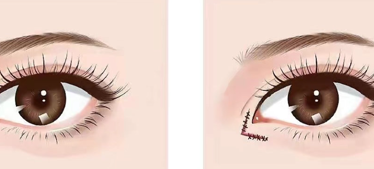 二、關(guān)于譚敏鋒內(nèi)眼角雙眼皮手術(shù)的價(jià)格，這些信息你需要了解www.sorencai.cn