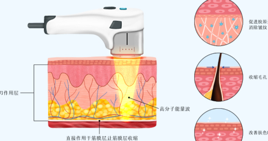 深圳美萊超聲炮價格3000元起，輪廓清晰一目了然，性價比不錯