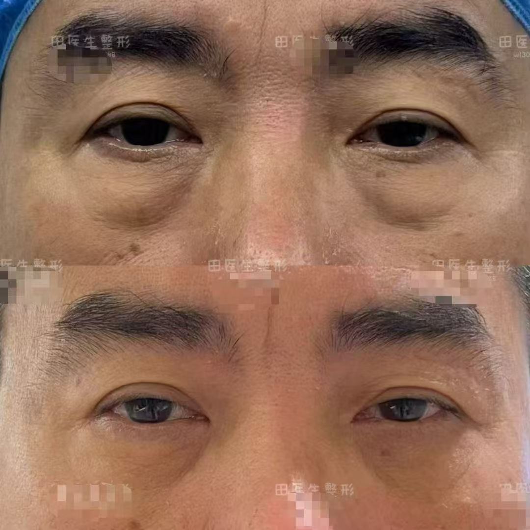 朱冠峰醫(yī)生祛眼袋預約方式與注意事項