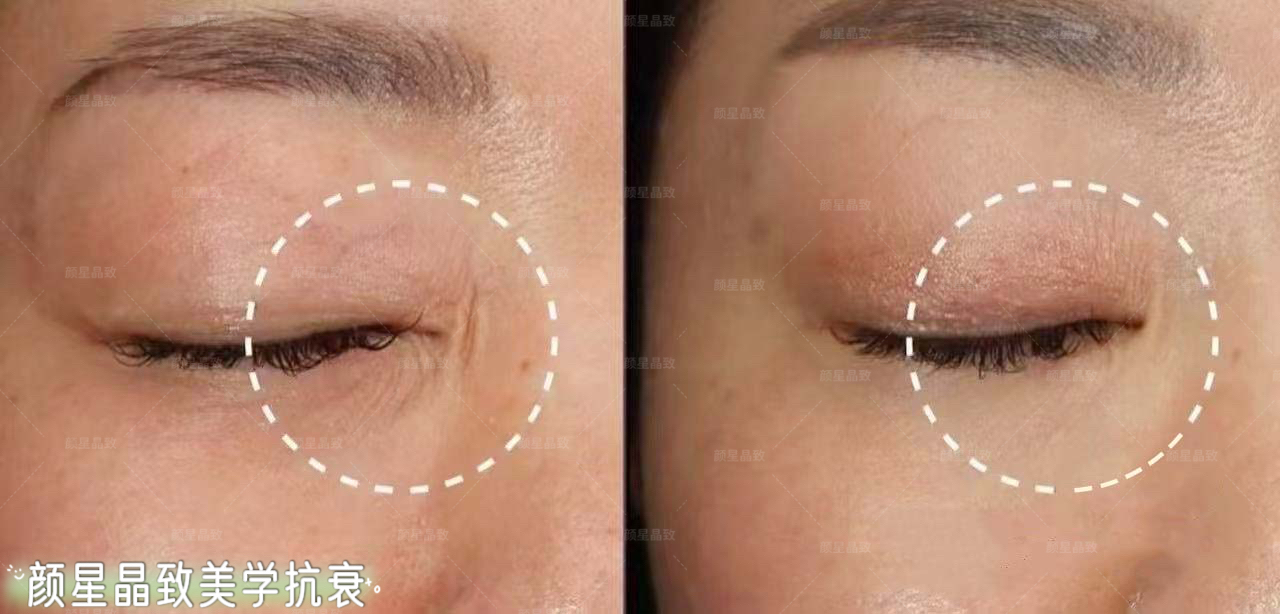 王永書注射降顴骨技術(shù)解析www.sorencai.cn