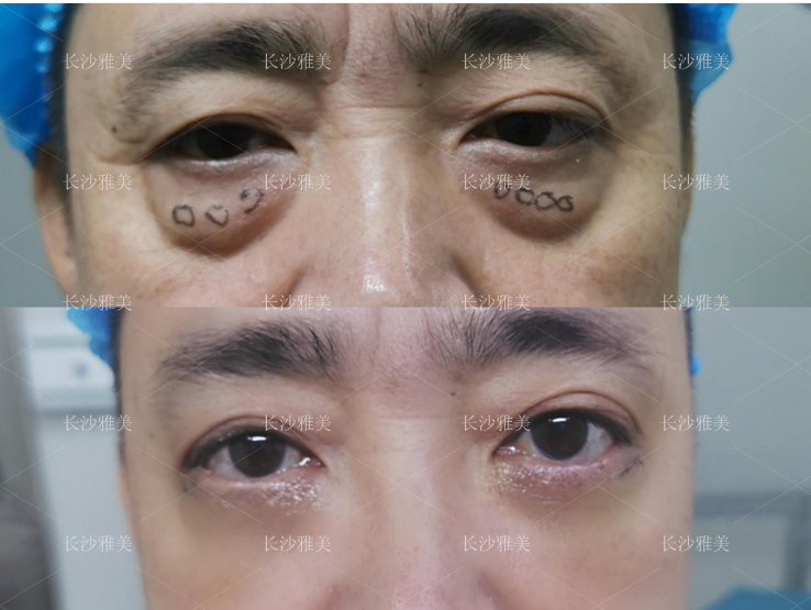 朱冠峰醫(yī)生祛眼袋技術臨床成效見證
