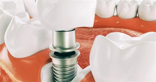 單顆種植牙演示