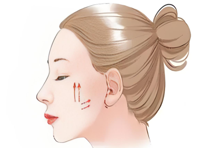 內(nèi)窺鏡拉皮除皺手術(shù)無(wú)明顯疤痕