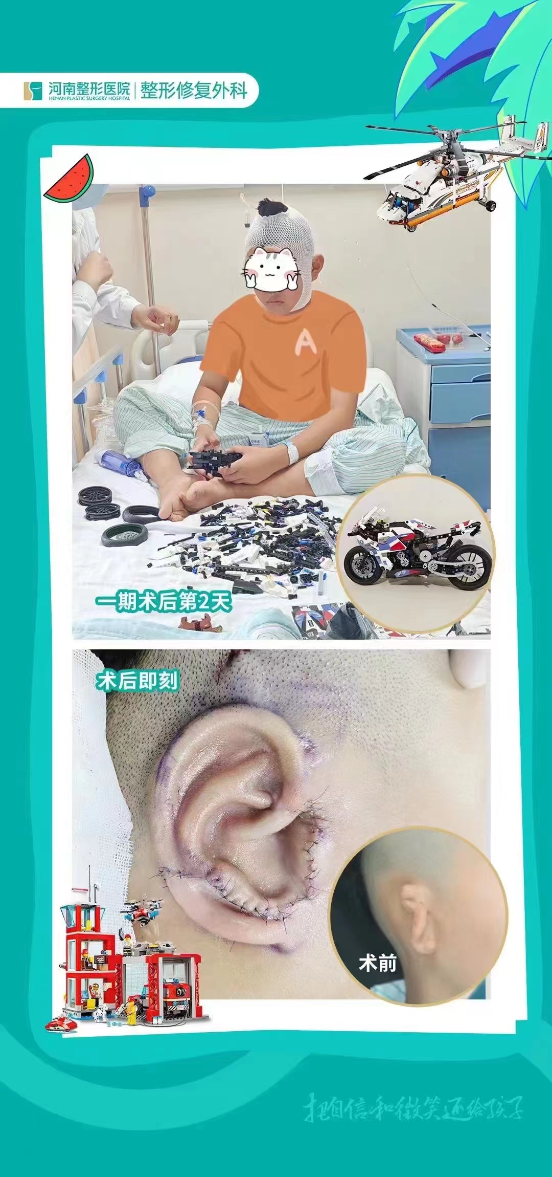 張正文耳再造五大優(yōu)勢，揭秘如何通過精密醫(yī)術(shù)實(shí)現(xiàn)患者的自信回歸