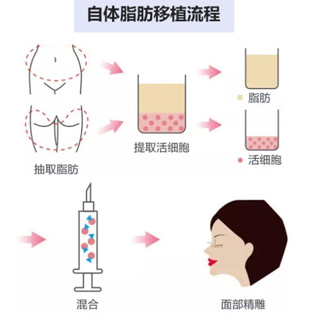案例二：腰腹吸脂+臀部填充，S曲線一次成型