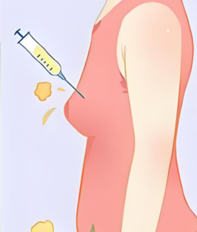 夏國興醫(yī)生隆胸手術(shù)理念與技術(shù)