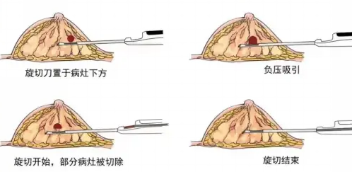 宋寶驥男性乳腺肥大切除價格影響因素