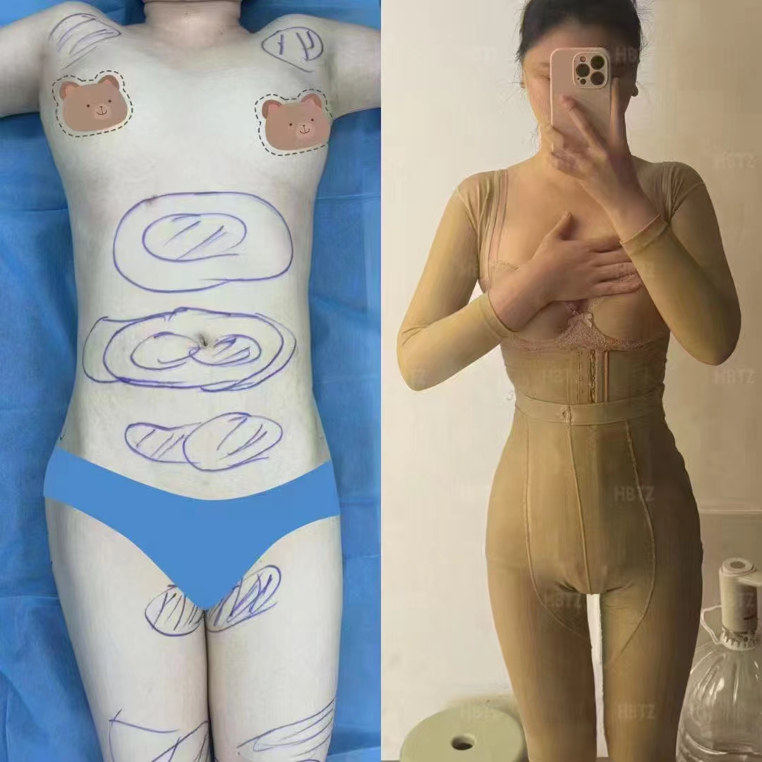 什么是吸脂隆胸？為什么越來越多人選擇它？