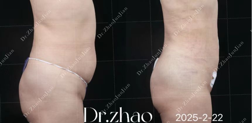 北京奧爾貝德整形饅化臉修復(fù):通過“減法美學(xué)”重塑面部折疊度與骨性支撐