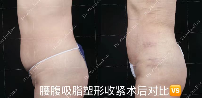 北京奧爾貝德整形饅化臉修復(fù):處理復(fù)雜再生材料與脂肪過量www.sorencai.cn