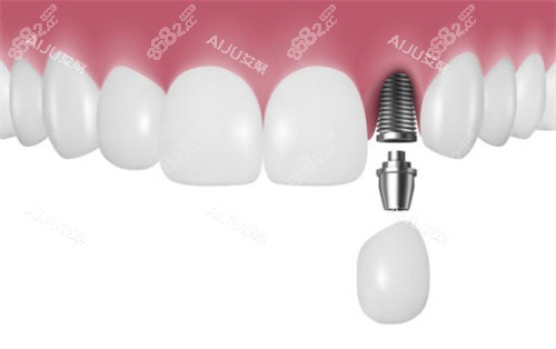 前牙區(qū)種植牙示意圖 前牙區(qū)種植牙示意圖