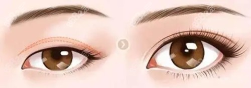 上瞼下垂整形前后對比 上瞼下垂整形前后對比