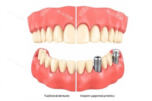 種植牙牙頜動畫圖 種植牙牙頜動畫圖