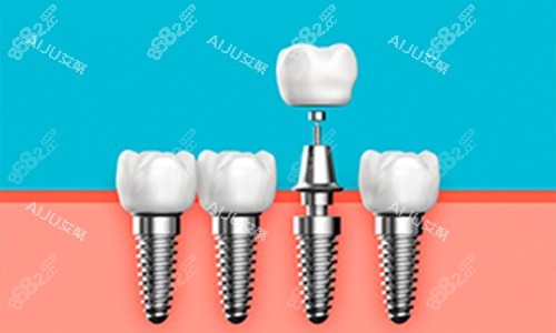 種植牙展示圖 種植牙展示圖