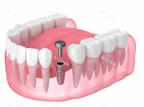 種植牙愈合基臺透視動畫 種植牙愈合基臺透視動畫