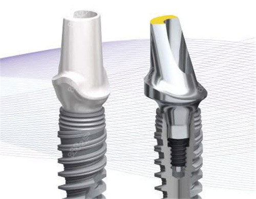 諾貝爾種植牙示意圖