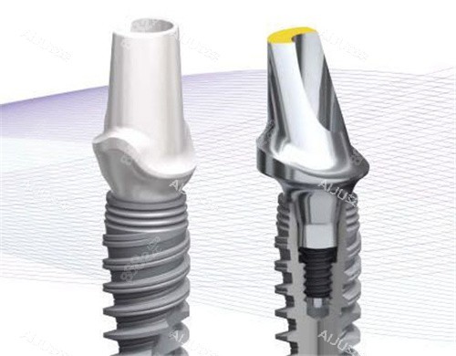 諾貝爾種植牙示意圖